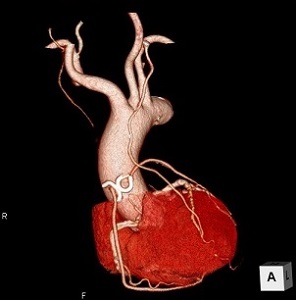 心臓バイパス術後の心臓の3D画像