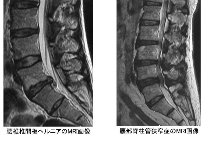 腰椎椎間板ヘルニアと腰部脊柱管狭窄症のMRI画像