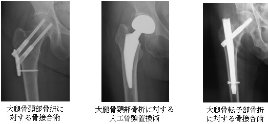 大腿骨頸部骨折に対する骨接合術、大腿骨頸部骨折に対する人工骨頭置換術、大腿骨転子部骨折に対する骨接合術のレントゲン写真