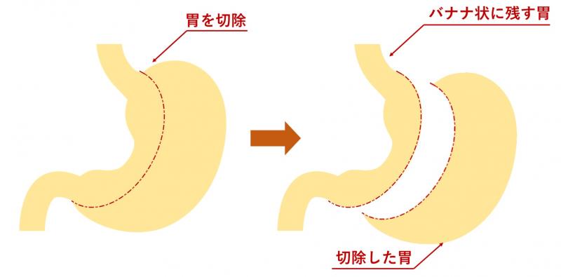 胃を手術でバナナ状に切除する模式図