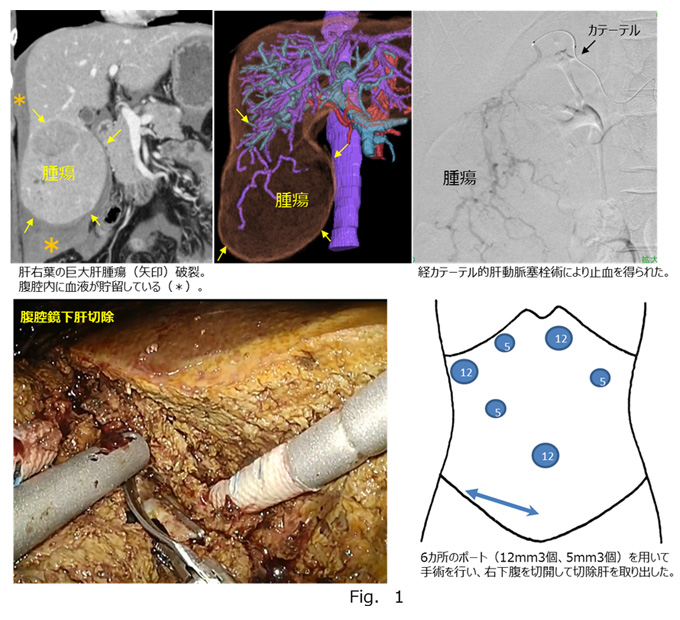 Fig.1の画像。肝右葉の巨大肝腫瘍破裂。腹腔内に血液がちゅお流している画像と腹腔鏡下肝切除。6か所のポートを用いて手術を行い、右下腹を切開して切除肝を取り出した。