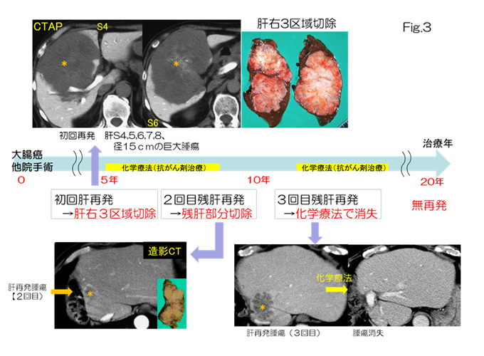 Fig.3の画像。大腸がん他院手術から5年目付近初回肝再発→肝右3区域切除、2回目残肝再発→残肝部分切除。10年目付近で3回目残肝再発→化学療法で消失。20年目付近でも無再発