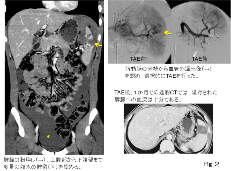 Fig.2の画像。脾臓は粉砕し上腹部から下腹部まで多量の腹水の貯蓄を認める。脾動脈の分岐から血管外漏出像を認め、選択的にTAEを行った。TAE後1か月での造影CTでは、温存された脾臓への血流は十分である。