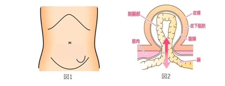 図1：足の付け根の鼠径部が膨れているイメージ図、図2：鼠径部の筋肉に穴が空いているイメージ図