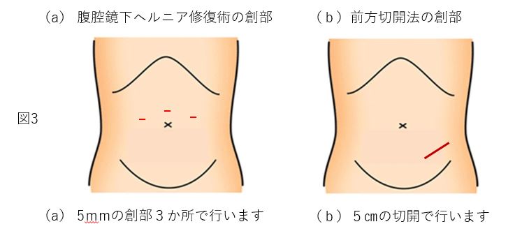 図3:a腹腔鏡下鼠経ヘルニア修復術イメージ図。5mmの創部3ヶ所で行います。b前方切開法のイメージ図。5cmの切開で行います。