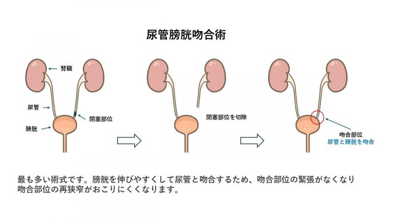 尿管膀胱吻合術