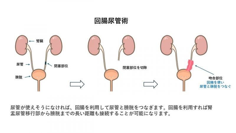 回腸尿管