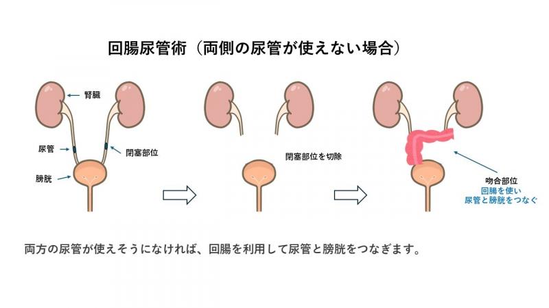 回腸尿管2