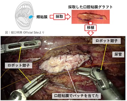 ロボット手術
