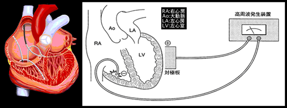 アブレーション図