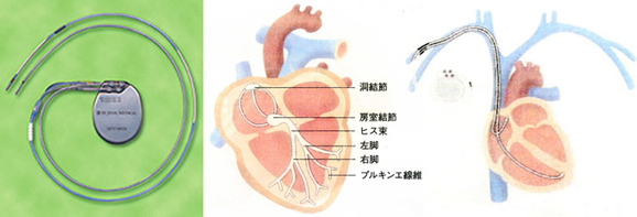 ペースメーカー実物及び、使用イメージ図