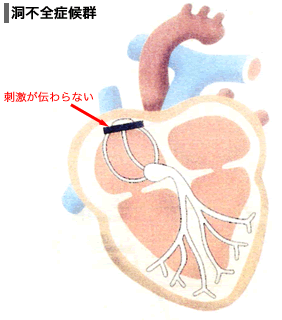 洞不全症候群イメージ図