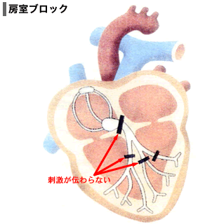 房室ブロックイメージ図