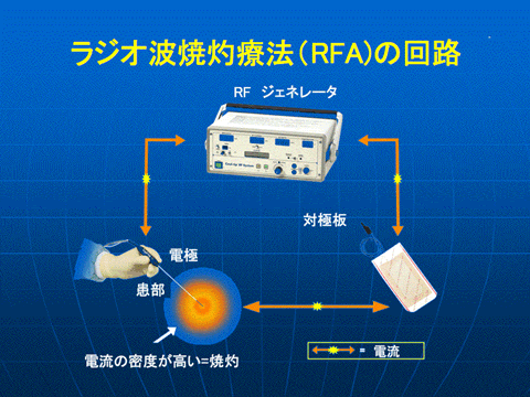 ラジオ波焼灼術イメージ図