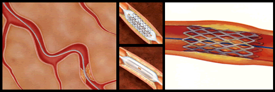 血管拡張術のイメージ図
