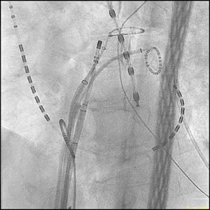 肺静脈隔離術の画像