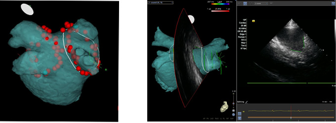 心臓の3Dイメージ図、中心部周辺に赤い丸がある。