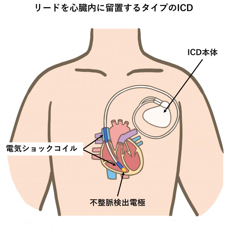 icd