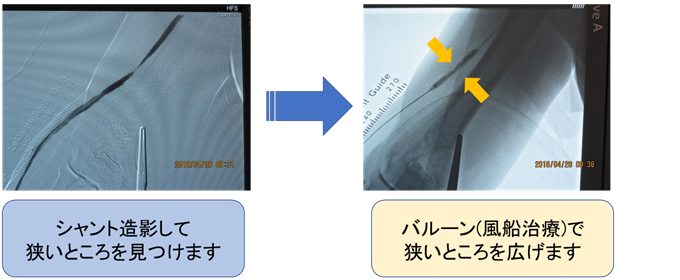 シャント造影して狭いところを見つけます。バルーン(風船治療)で狭いところを広げます。