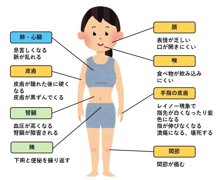全身性強皮症の部位ごとの症状