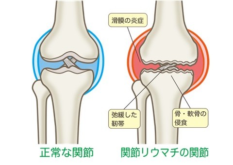 関節リウマチの関節画像