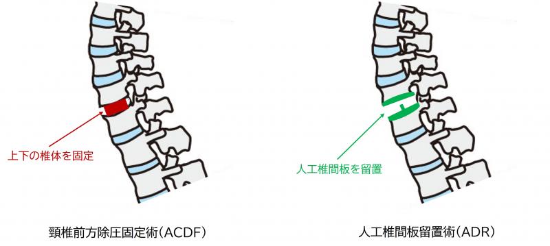 acdfadr