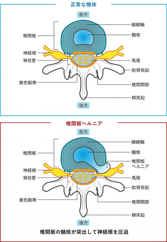 heruniatossyutu