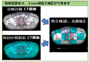 照射位置を0.1mm単位で補正ができます。治療計画CT画像と毎回の照射前CT画像を照合確認し、位置補正します。