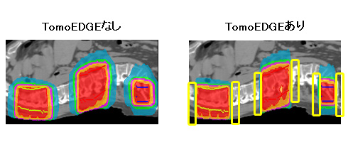 TomoEDGEなしの場合とある場合の比較画像