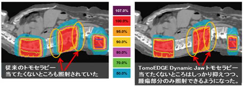 従来のトモセラピーは当てたくないところも照射されていた。TomoEDGE Dynamic Jaw トモセラピーは当てたくないところはしっかり抑えつつ、腫瘍部分のみ照射できるようになった。