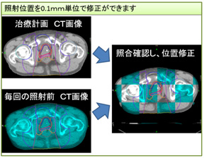 照射位置を0.1mm単位で修正ができます。治療計画CT画像と毎回の照射前CT画像を照合確認し、位置修正。