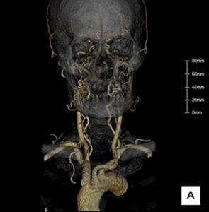 頭頸部血管の3D画像