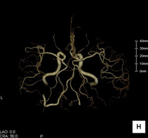頭部血管の3D画像