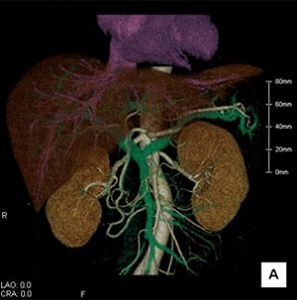 腹部血管の3D画像