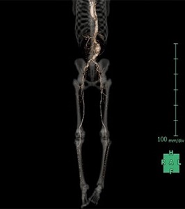 胸部から下肢の血管の3D画像