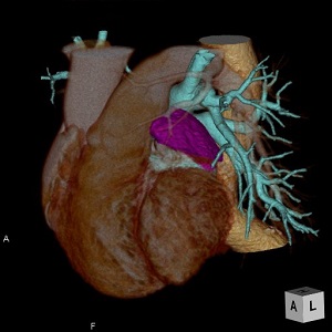 心臓術前3D画像