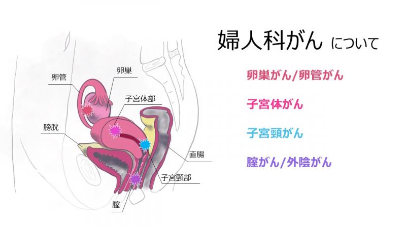婦人科がんの画像