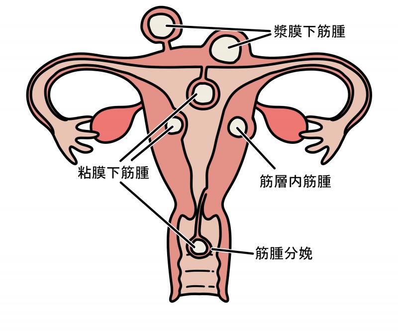 子宮筋腫の画像