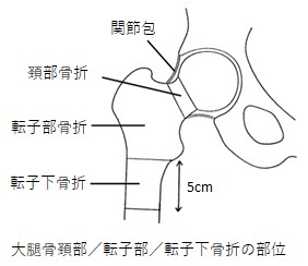 大腿骨頸部、転子部、転子部骨折の部位