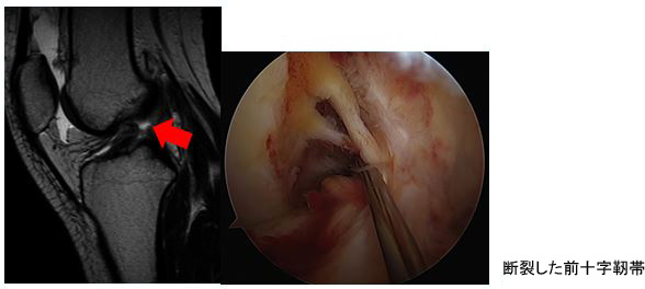 断裂した前十字靭帯のMRI画像と術中写真