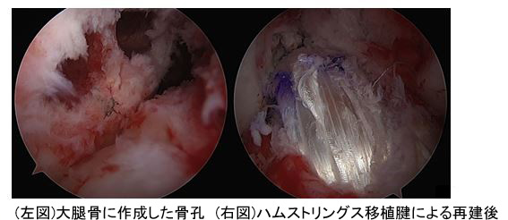 大腿骨に作成した骨孔とハムストリングス移植腱による再建後の写真