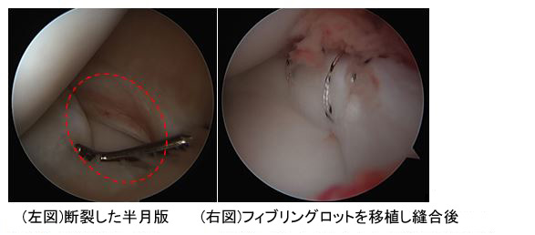 断裂した半月板とフィブリングロットを移植縫合後の写真