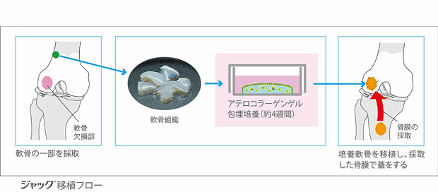 ジャック移植フロー。軟骨の一部を採取した軟骨組織を約4週間アテロコラーゲンゲル包理培養を行う。そして、軟骨欠損Bに培養軟骨を移植し、採取した骨膜で蓋をする