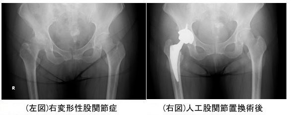 (左図)右変形性股関節症(右図)人工股関節置換術後