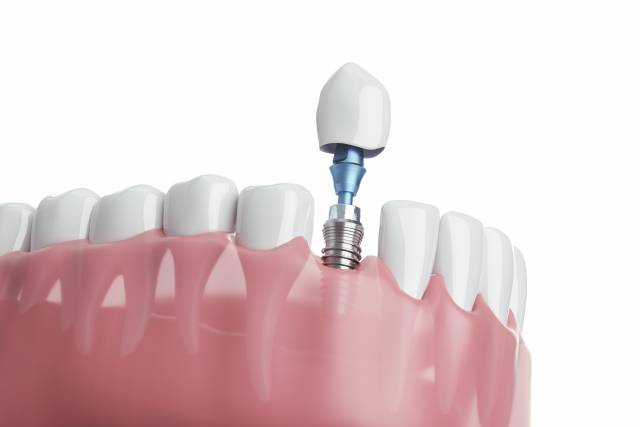 implant