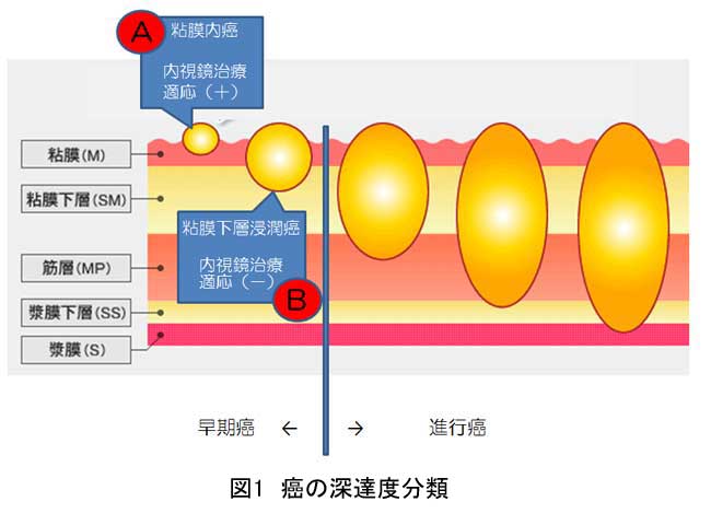 食道癌 深達度診断