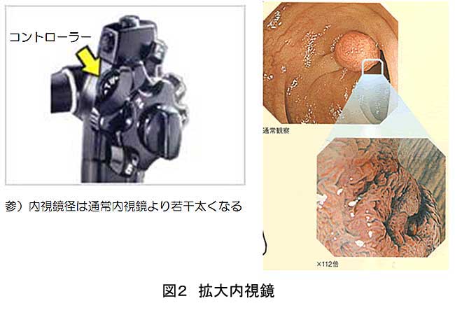 図2：拡大内視鏡