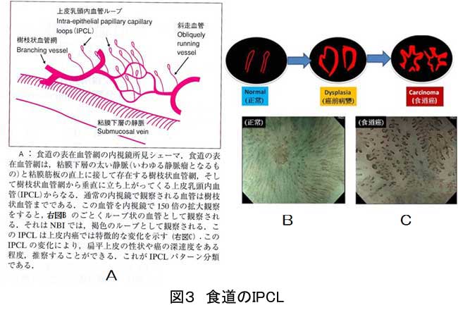 図3：食道のIPCL。A：食道の表在血管網の内視鏡所見シェーマ。食道の表在血管網は、粘膜下層の太い静脈と粘膜筋板の直上に接して存在する樹枝状血管網、そして樹枝状血管網から垂直に立ち上がってくる上皮乳頭内出血（IPCL）からなる。通常の内視鏡で観察される血管は樹枝状血管までである。この血管を内視鏡で150倍の拡大観察をすると、ループ状の血管として観察される。それはNBIでは褐色のループとして観察される。このIPCLは上皮内がんでは特徴的な変化を示す。このIPCLの変化により、扁平上皮の性状やがんの深達度をある程度、推察することができる。これがIPCLパターン分類である。