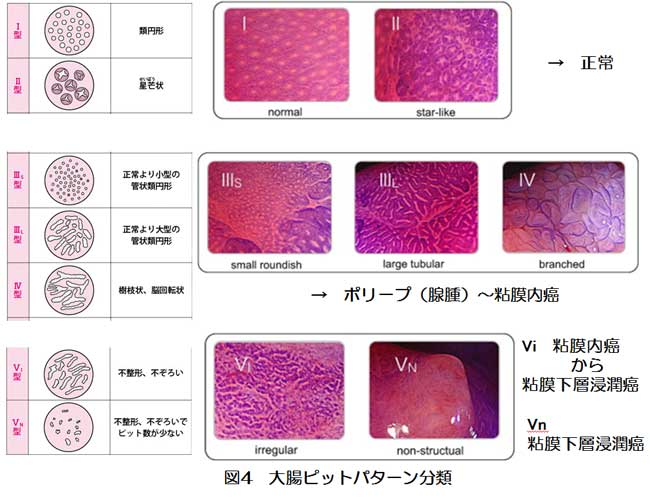 図4：大腸ピットパターン分類。腺口形態を見ることで、正常か、ポリープ（腺腫）から粘膜内がんか、粘膜内がんから粘膜下層浸潤がんか、粘膜下層浸潤がんかが分かる。