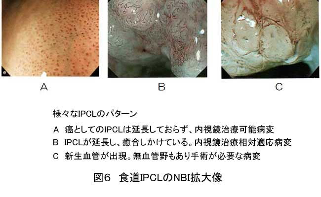 図6：食道IPCLのNBI拡大像。様々なIPCLのパターン。A がんとしてのIPCLは延長しておらず、内視鏡治療可能病変。B ICPLが延長し、癒合しかけている。内視鏡治療相対適応病変。C 新生血管が出現。無血管野もあり手術が必要な病変